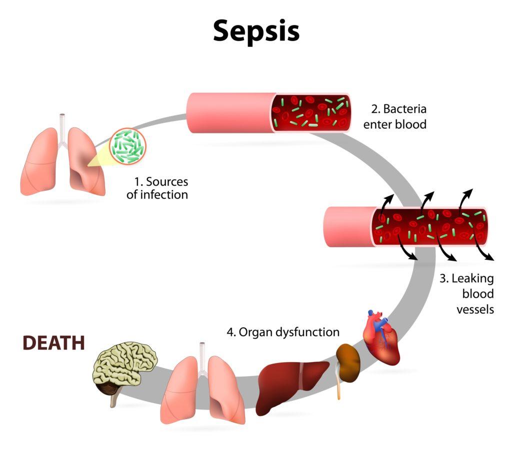 Stages of sepsis